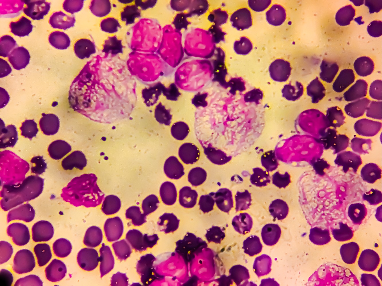 Acute lymphoblastic leukemia cells, also known as Burkitt leukemia cells, under a light microscope. Forms of Burkitt leukemia are included in the Compassionate Allowances list.